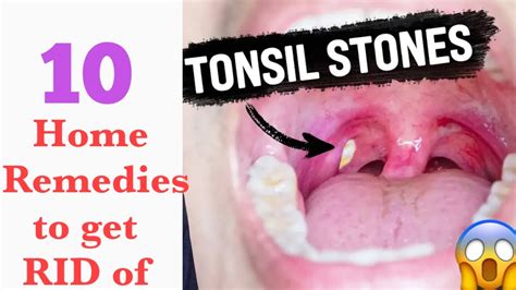 tonsil stones medical term